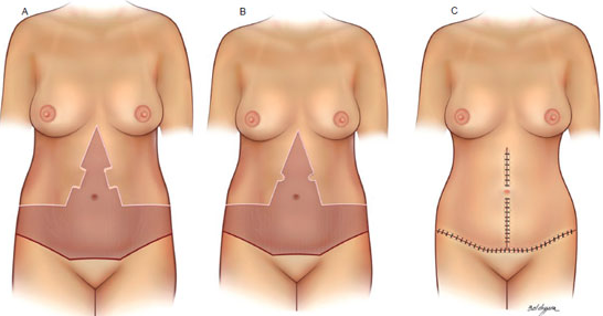 cirurgia de abdomen pos bariatrica